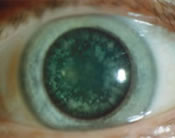 Cerulean Cataract