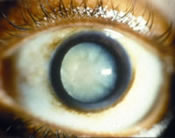 Dense (traumatic) Cataract