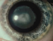 Lamellar Cataract