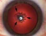 Posterior Sub-Capsular Cataract