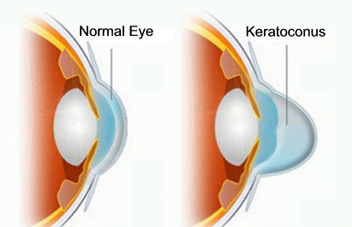 Keratoconus