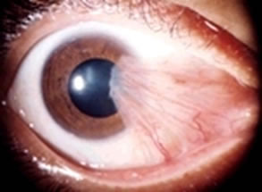 Pterygium Surgery