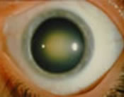 Nuclear Sclerotic Cataract